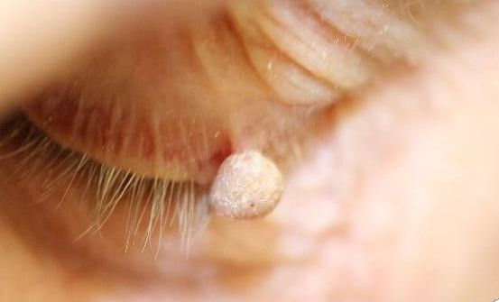 Verrues, Papillomes et Syringomes