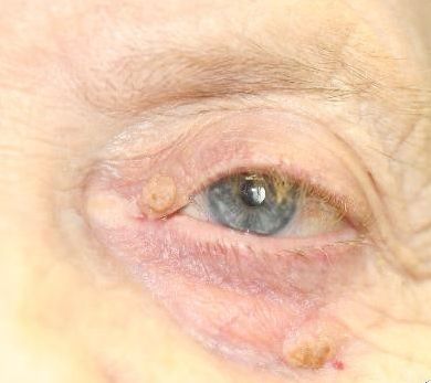 Verrues, Papillomes et Syringomes