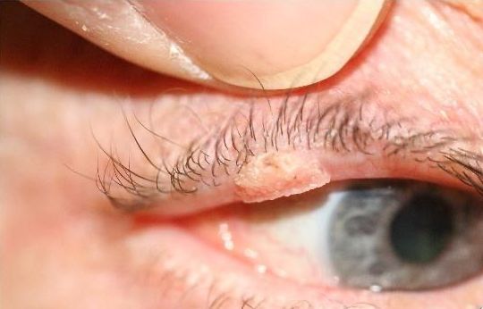 Verrues, Papillomes et Syringomes