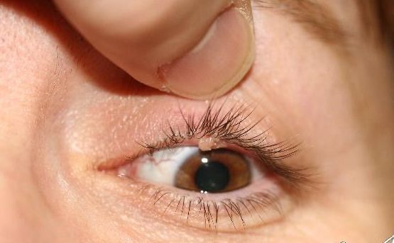 Verrues, Papillomes et Syringomes