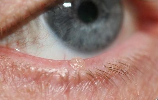 Verrues, Papillomes et Syringomes