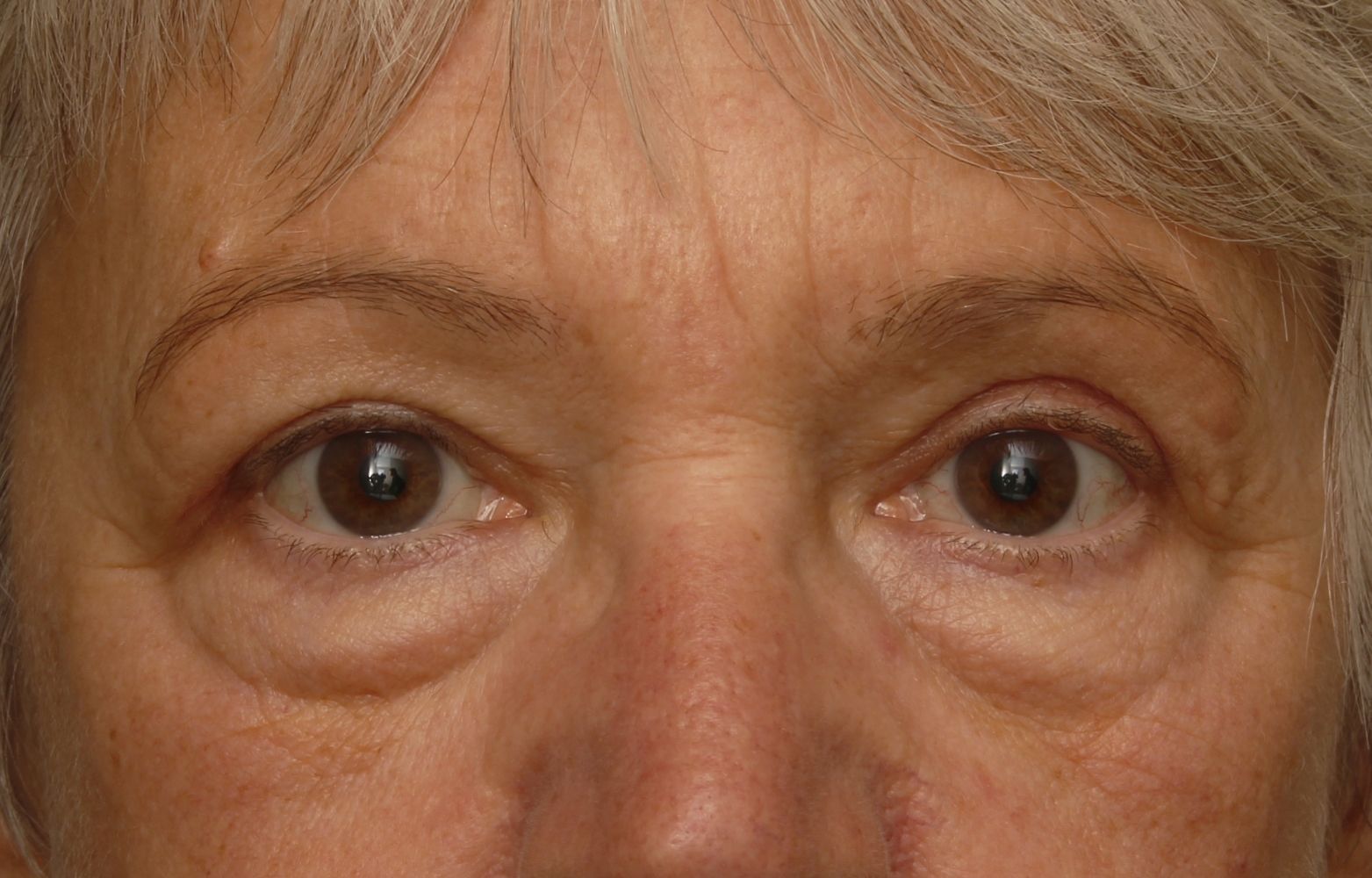 Chirurgie des paupières supérieures