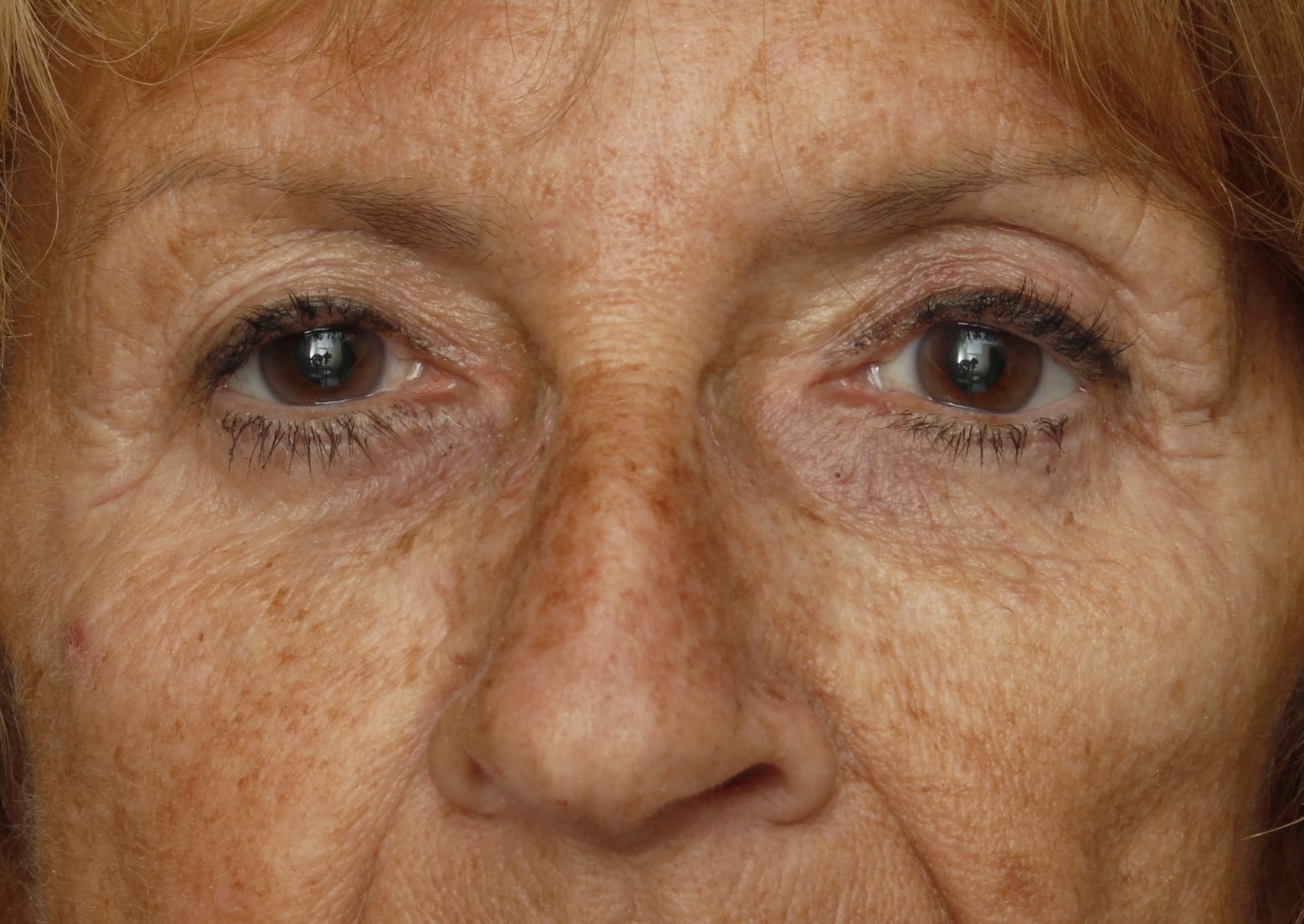 Chirurgie des 4 paupières