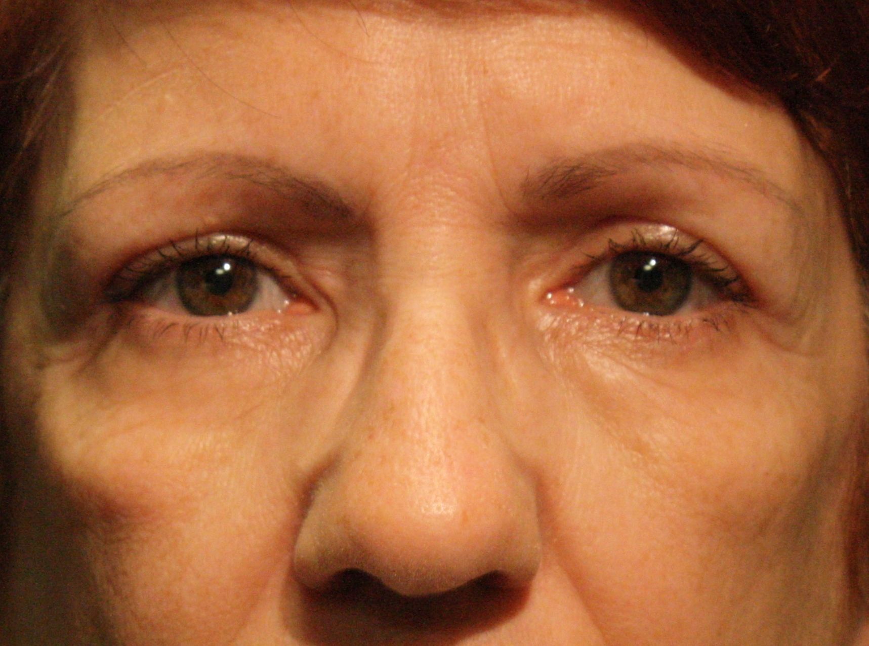 Chirurgie des paupières supérieures