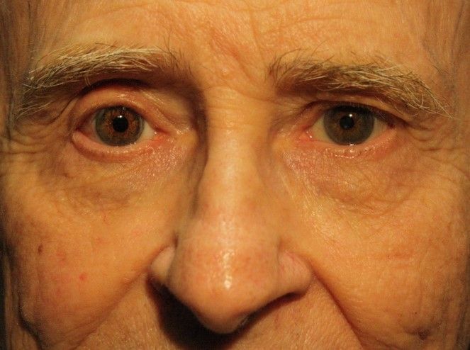 Correction de la ptose