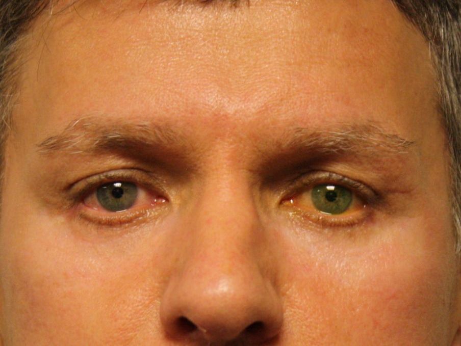 Resurfacage par peeling chimique