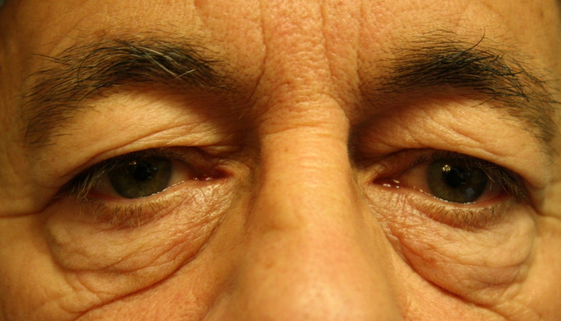 blepharoplastie 4 paupières