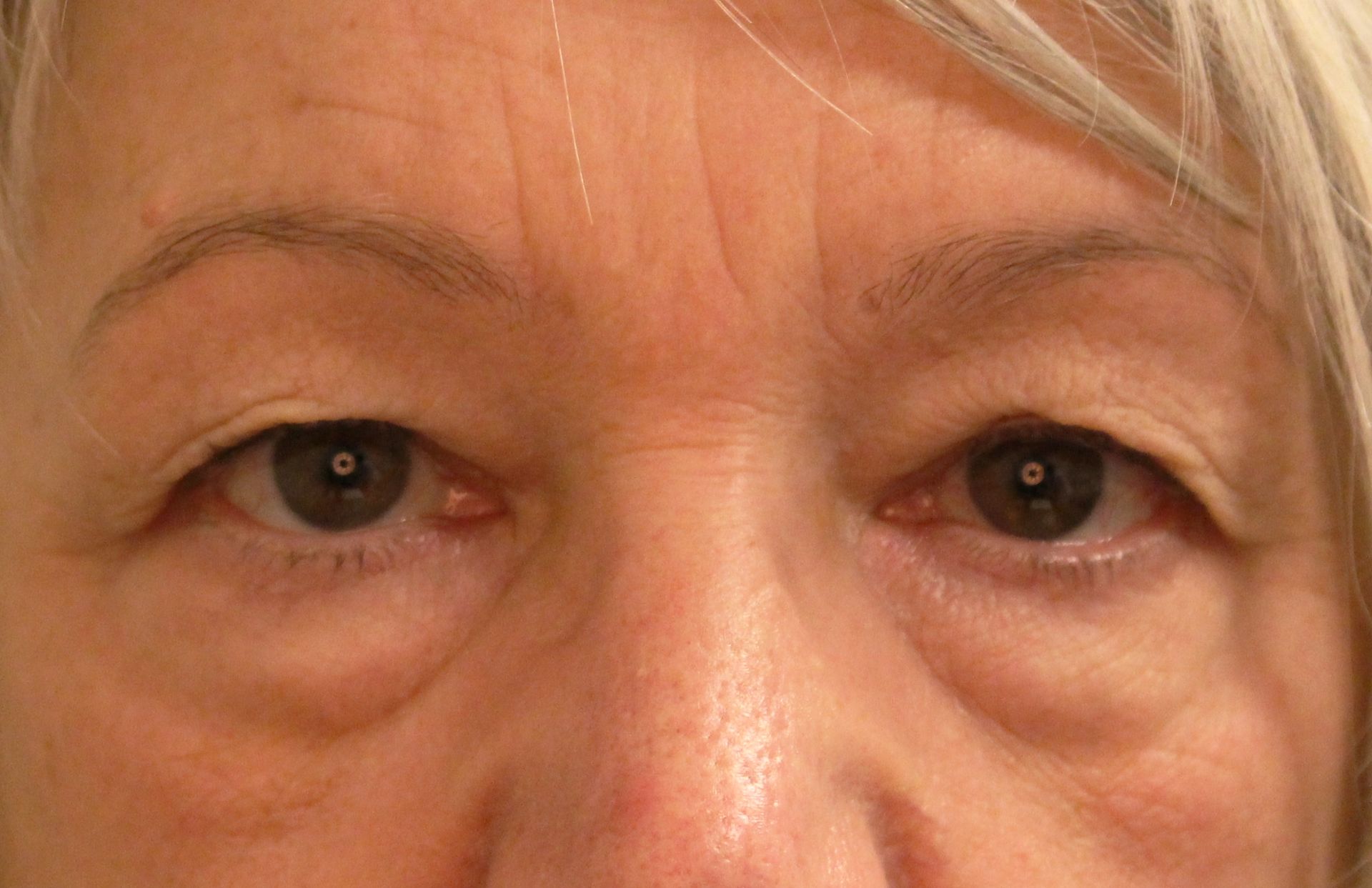 Chirurgie des paupières supérieures