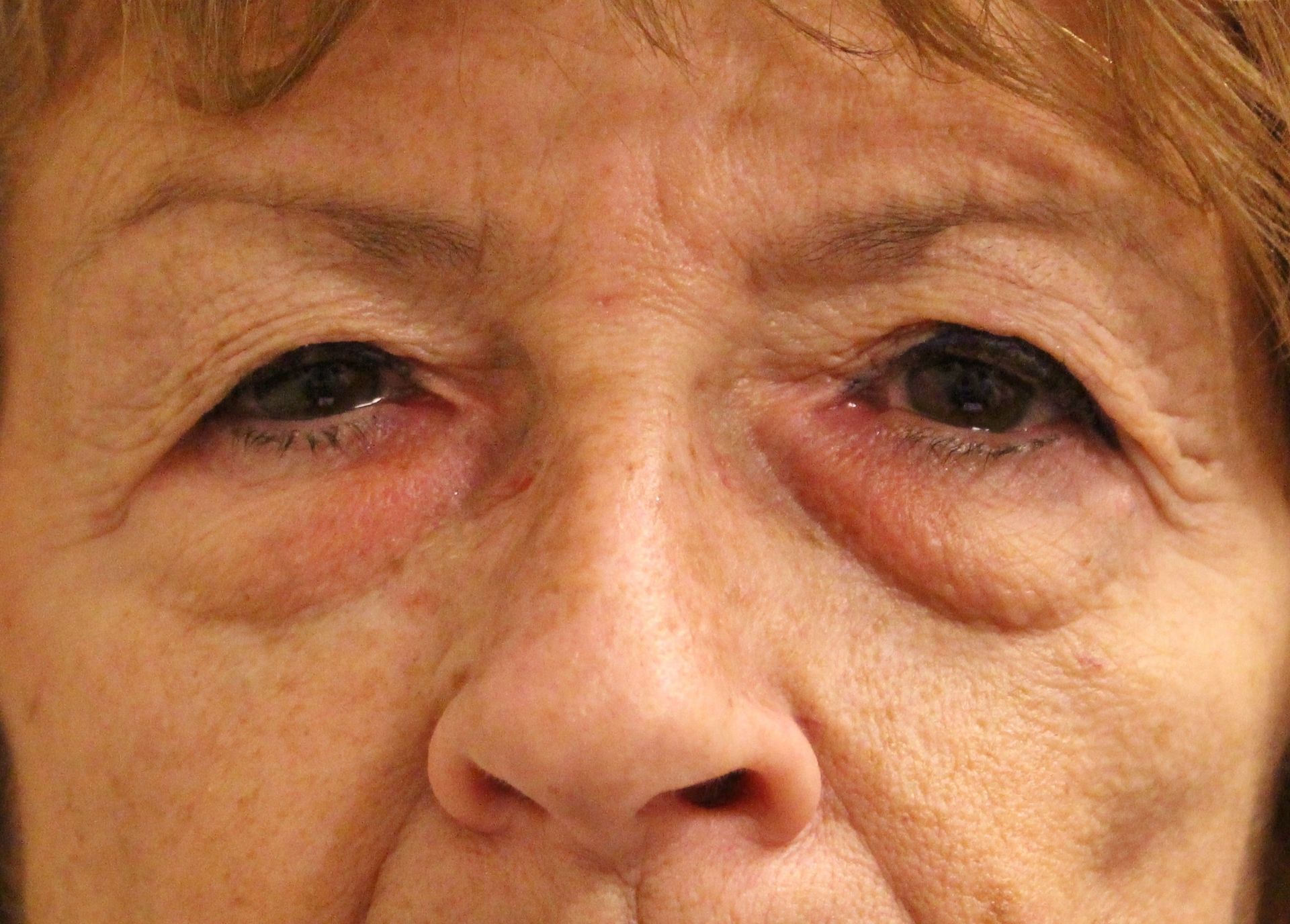 Chirurgie des 4 paupières