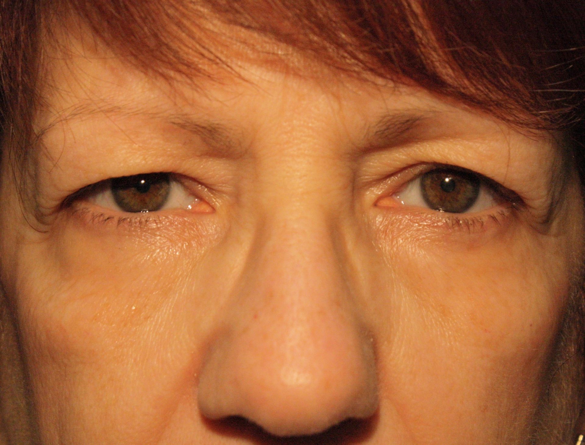 Chirurgie des paupières supérieures