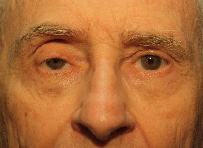 Correction de la ptose