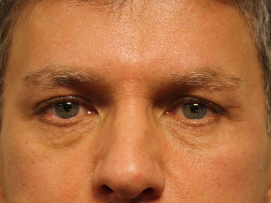 Resurfacage par peeling chimique