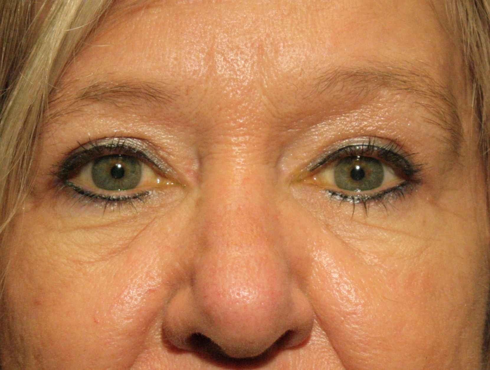 Chirurgie des paupières supérieures