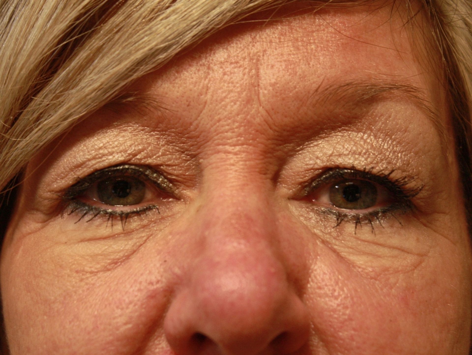 Chirurgie des paupières supérieures