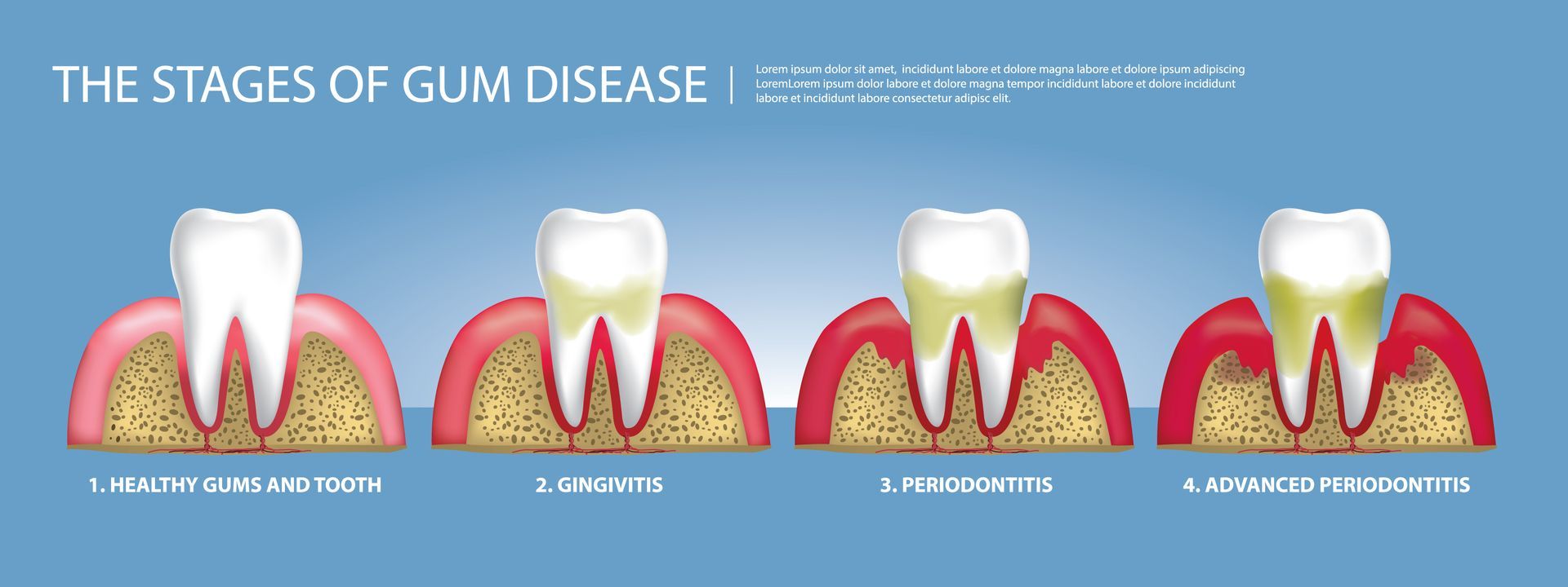 4 Stages of Gum Disease