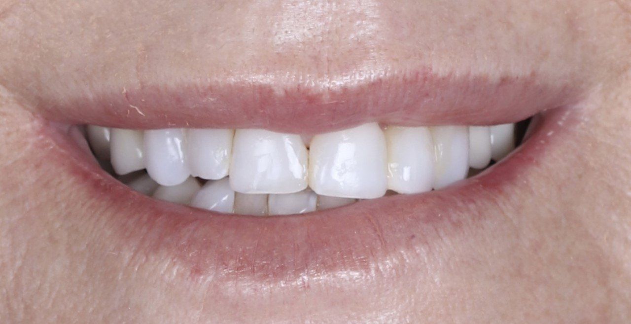 Before Teeth enhancement