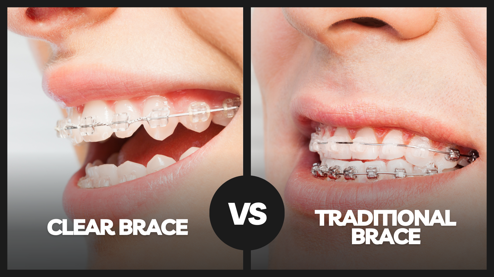A Comprehensive Guide to How Braces Work: Metal, Invisible, Ceramic, and  Lingual