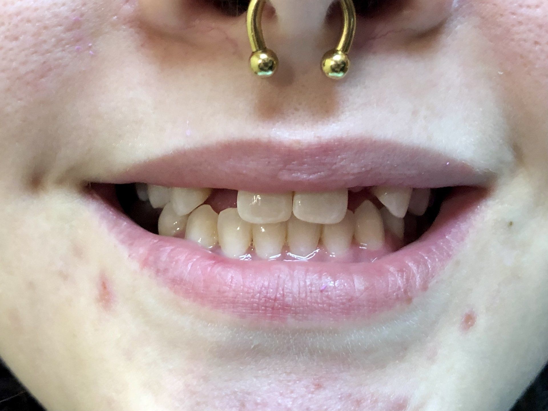 Before - Teeth whitening