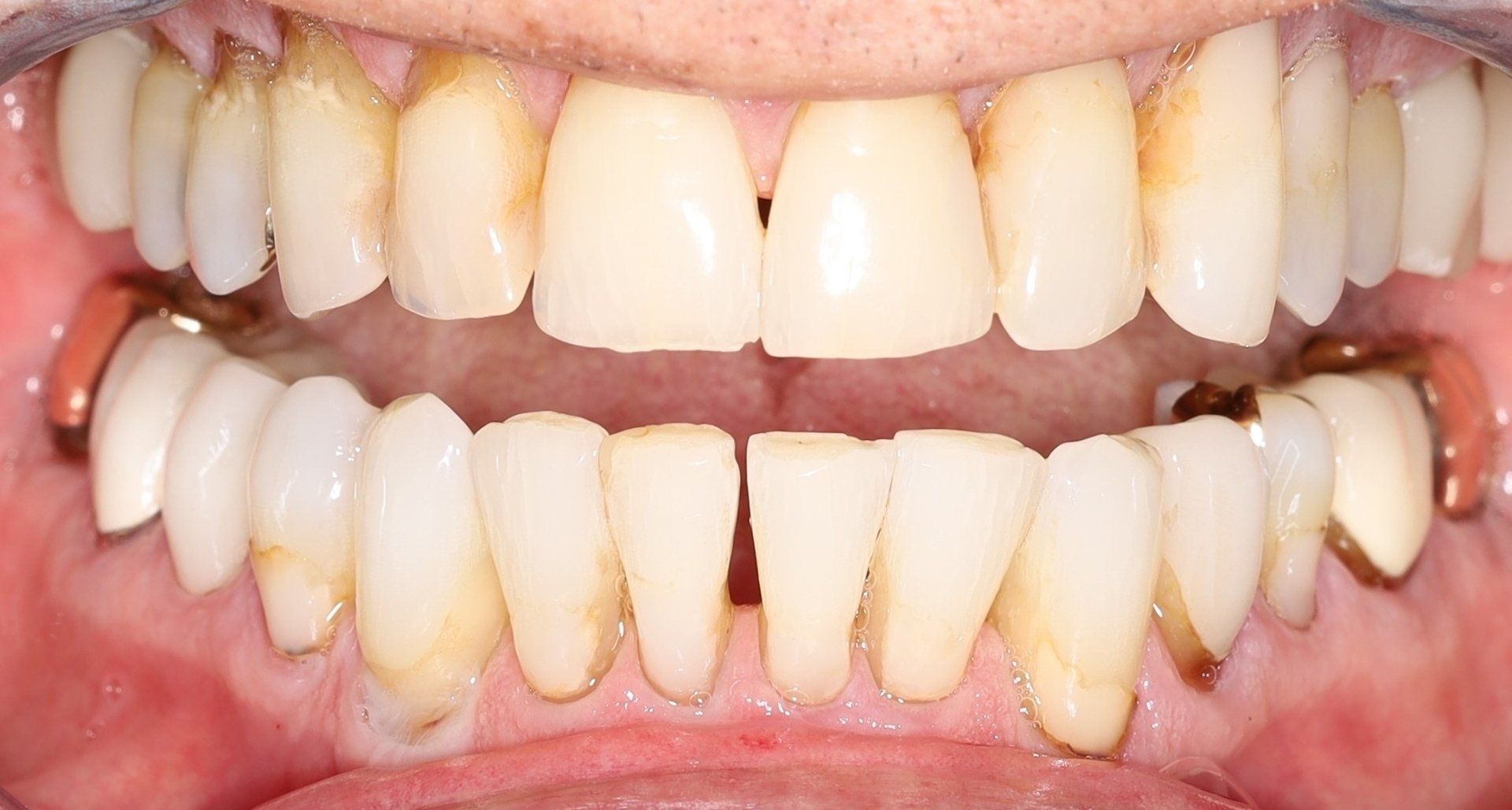 Before - Dental Veeners