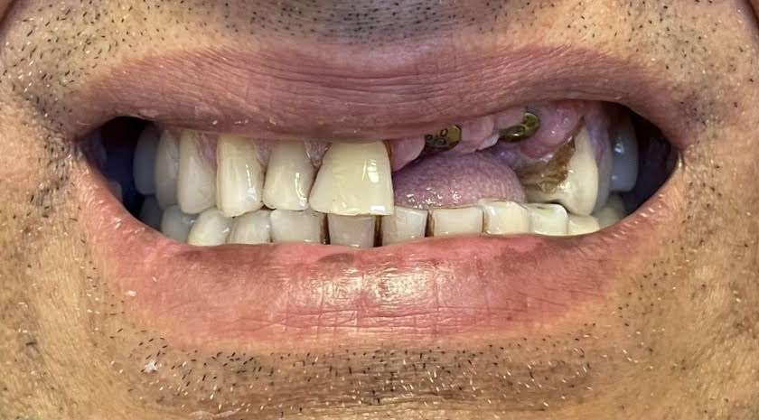 Before - missing teeth