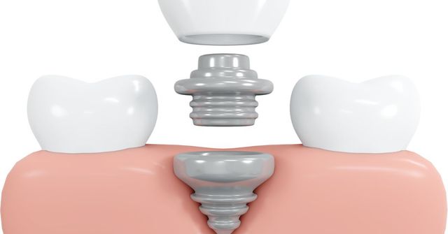 Definitive veneers and crowns prepared digitally using prosthetic