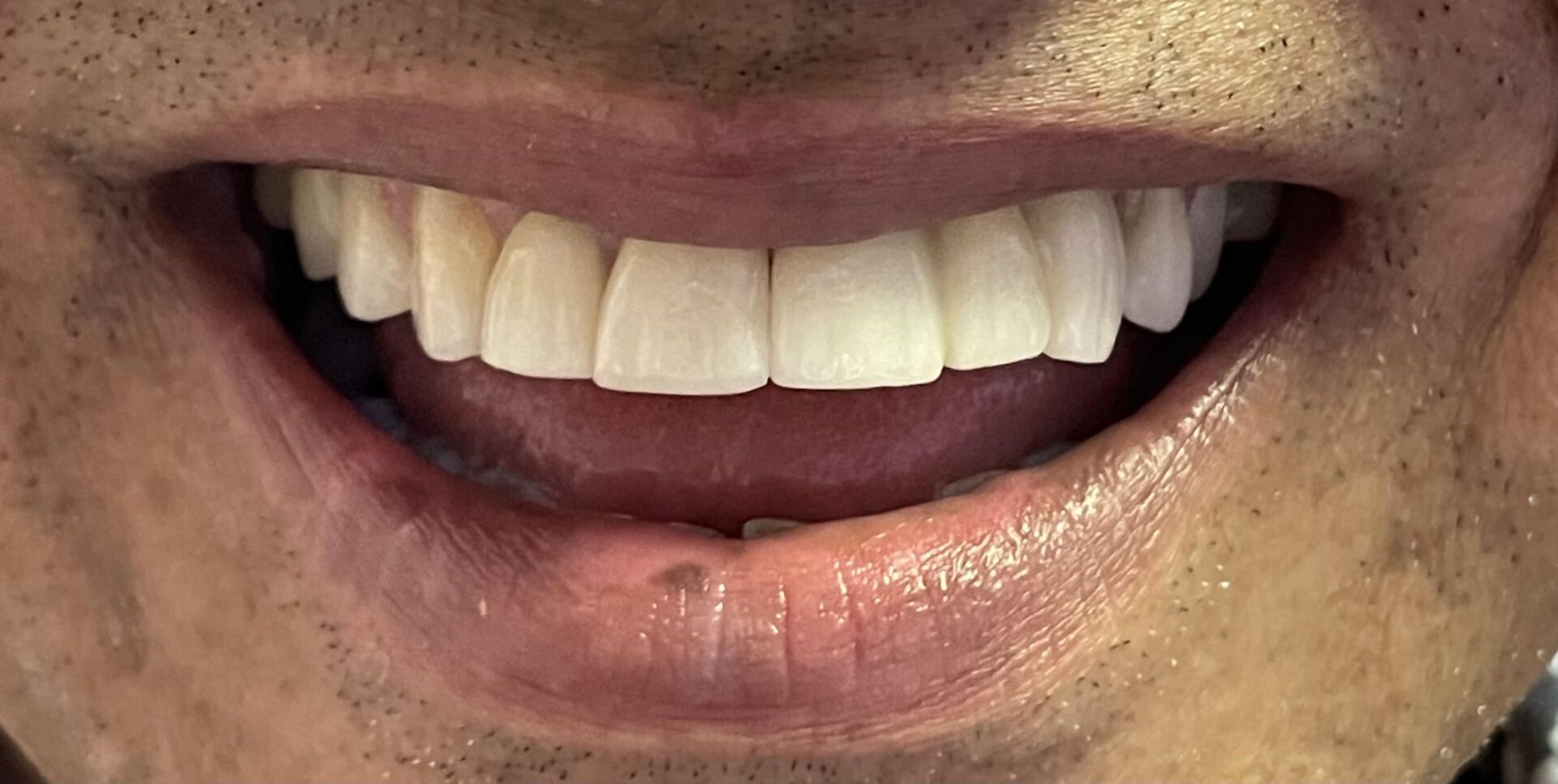 After - Veneers teeth