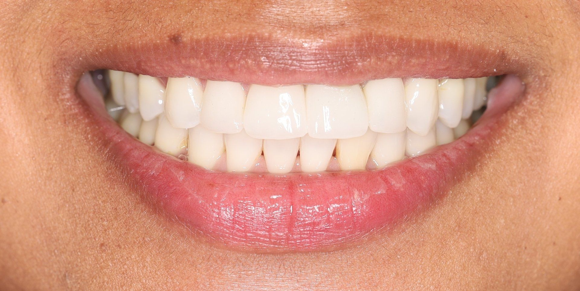 After - Whitening