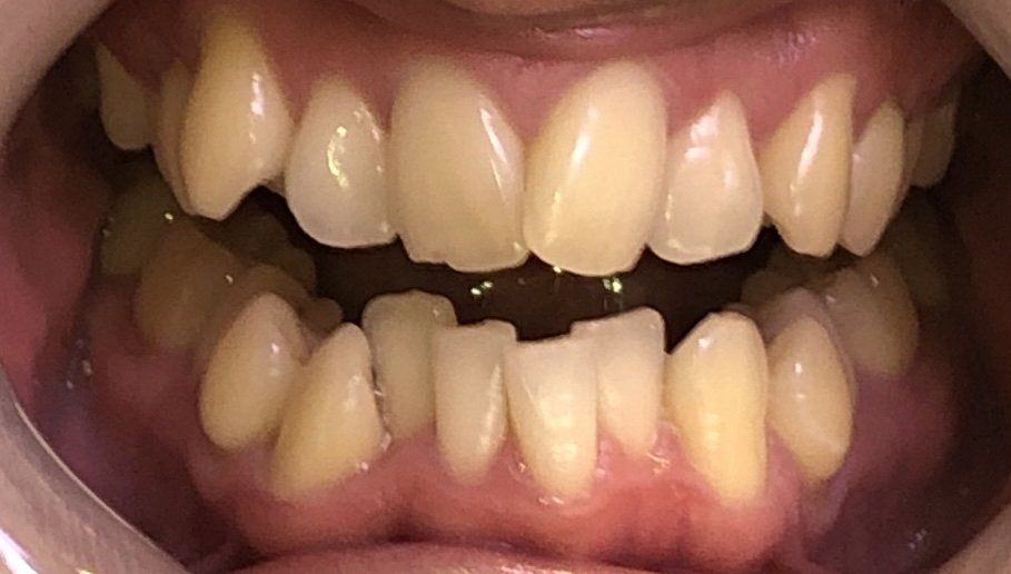 Before - Teeth aligners