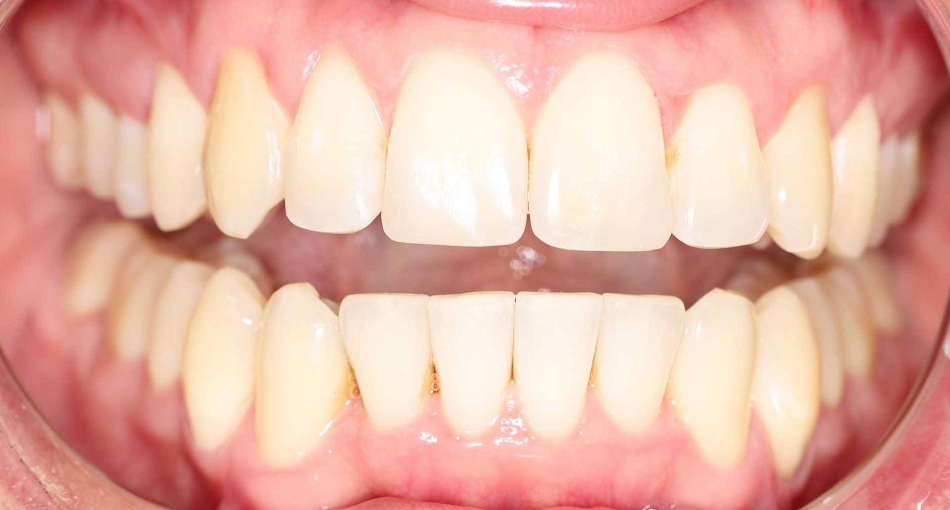 After - Teeth aligners