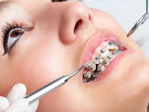 L'ortodonzia e gli apparecchi dentali