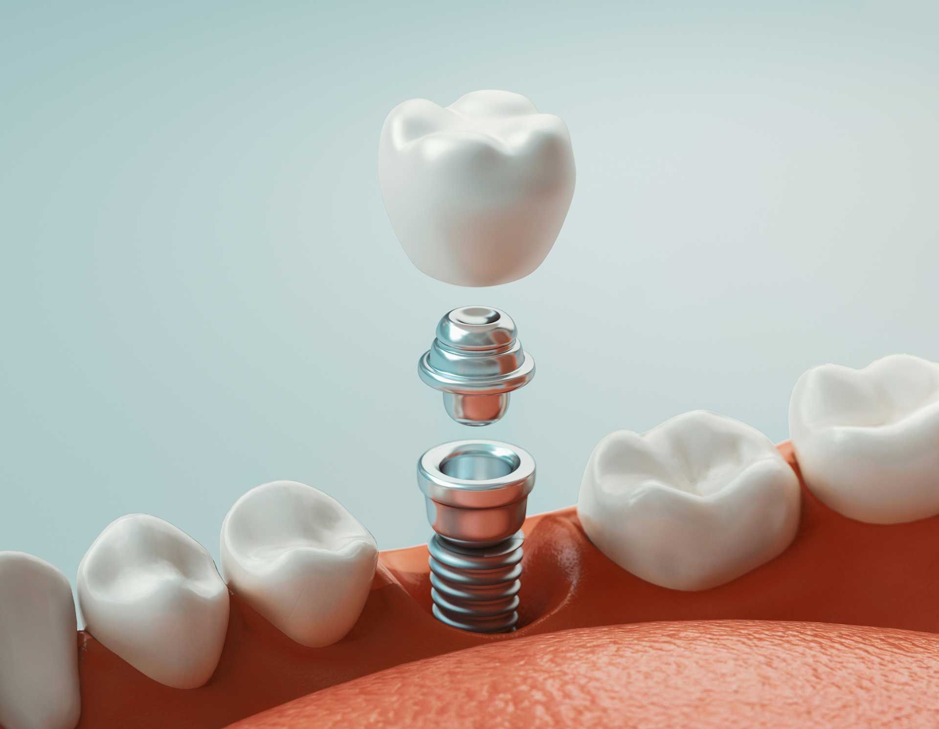 Diagram of a tooth implant: tooth crown, abutment, and screw, above gumline and adjacent teeth.