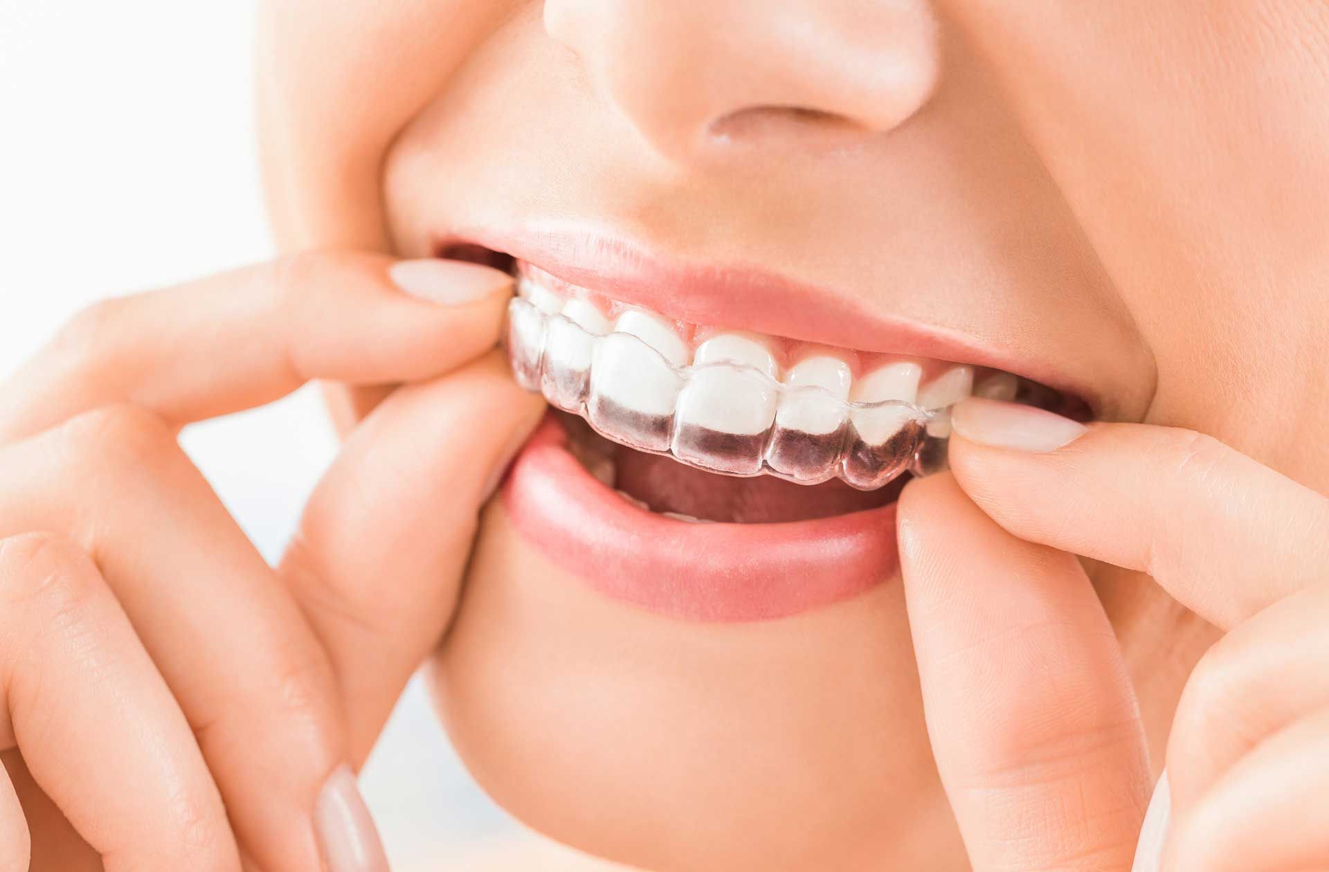 Person inserting clear aligners into mouth.