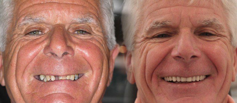 Dental Implants Birmingham