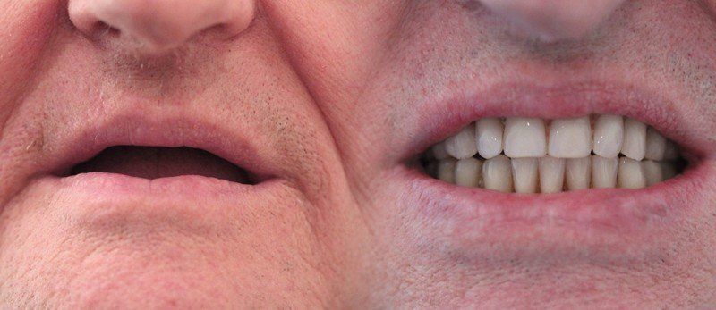 Dental Implants Birmingham