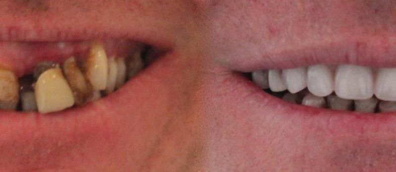 Dental Implants Birmingham