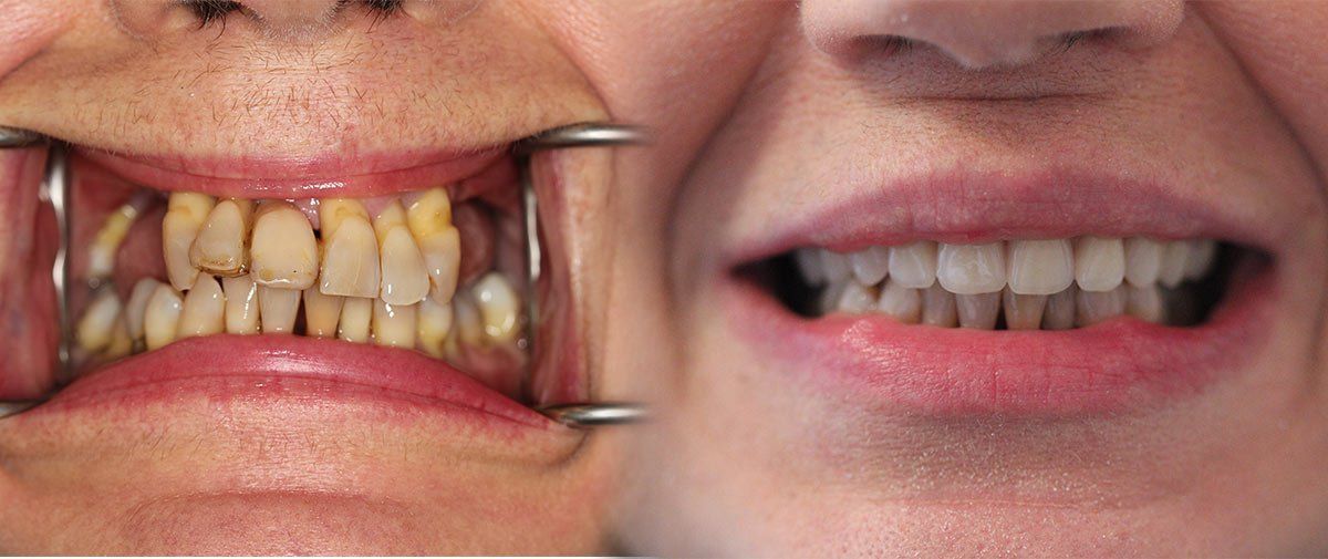 Dental Implants Birmingham