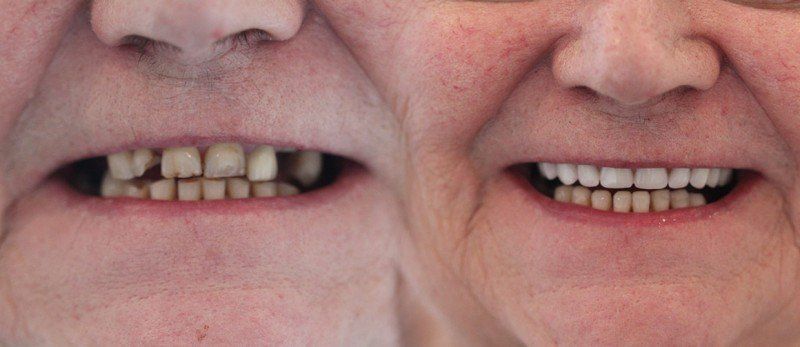 Dental Implants Birmingham