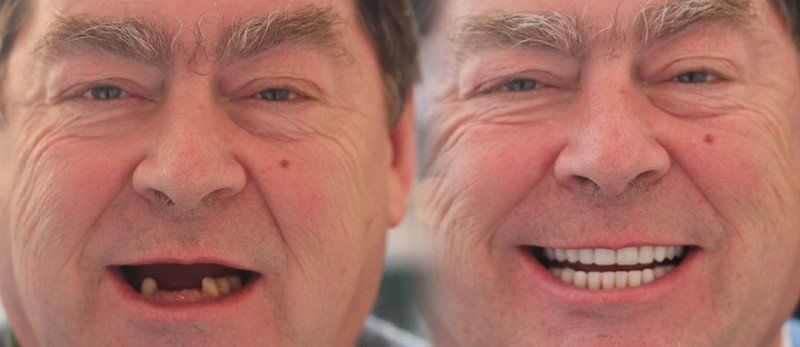 Dental Implants Birmingham