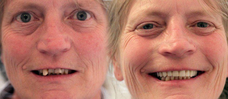 Dental Implants Birmingham