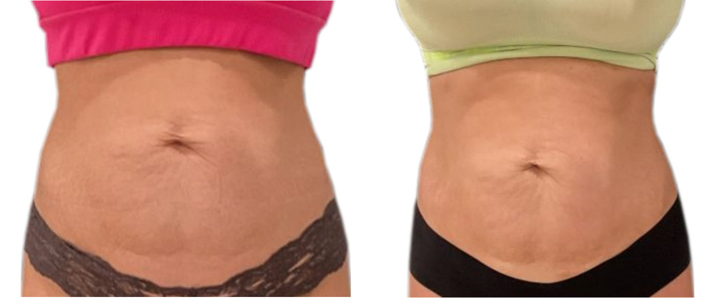 Side-by-side close-up of a torso with a flatter abdomen on the right after a reduction