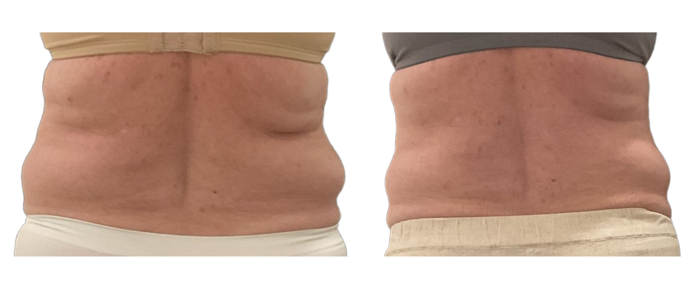 Side-by-side close-up of a bare abdomen, showing skin after treatment with different lighting or makeup effects