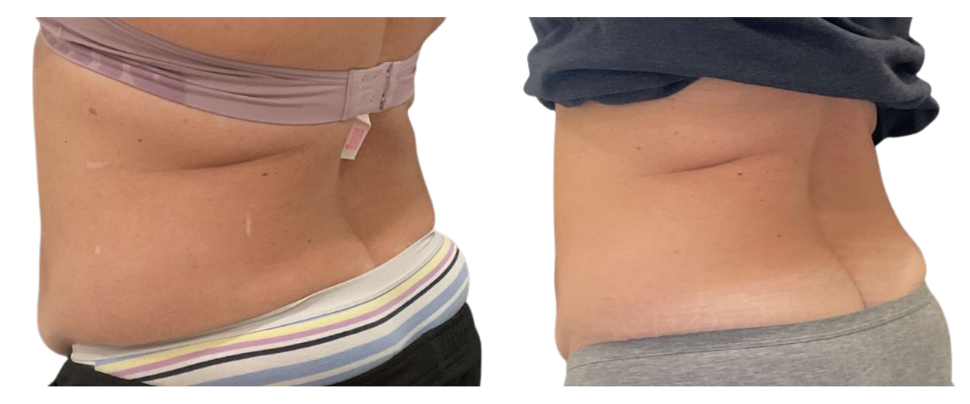 Side-by-side waistline photos showing a flatter abdomen on the right and a fuller abdomen on the left.