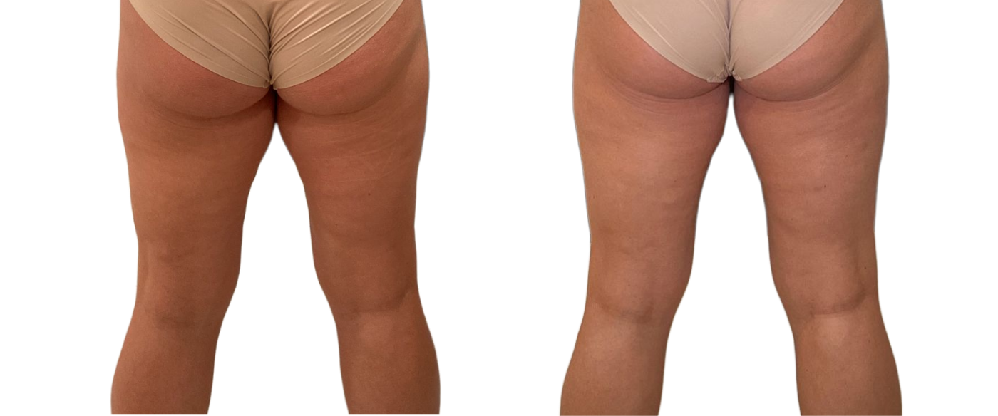 Two side-by-side views of a person’s lower back and thighs in tan underwear and stockings