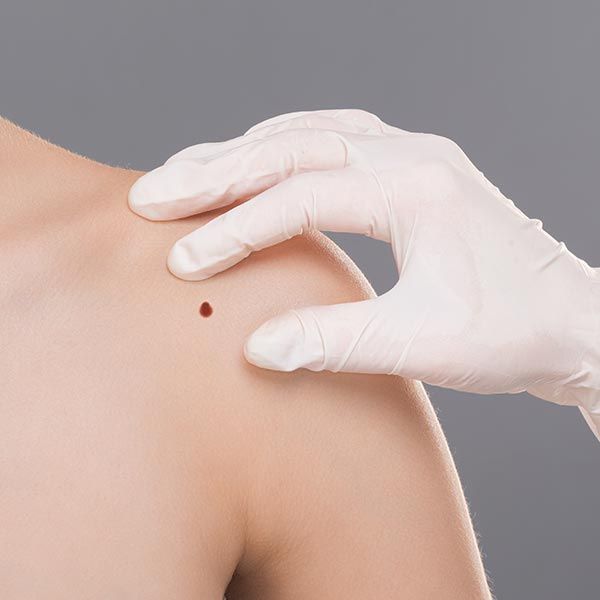 Dermatitis