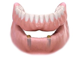 Dentures — Dentist Review X-Ray Result Of Patient In Newport News, VA