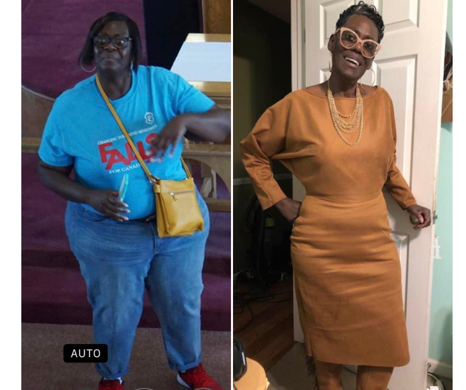 a before and after photo of a woman in a blue shirt and a brown dress | Simpsonville, SC | Oakview Medical