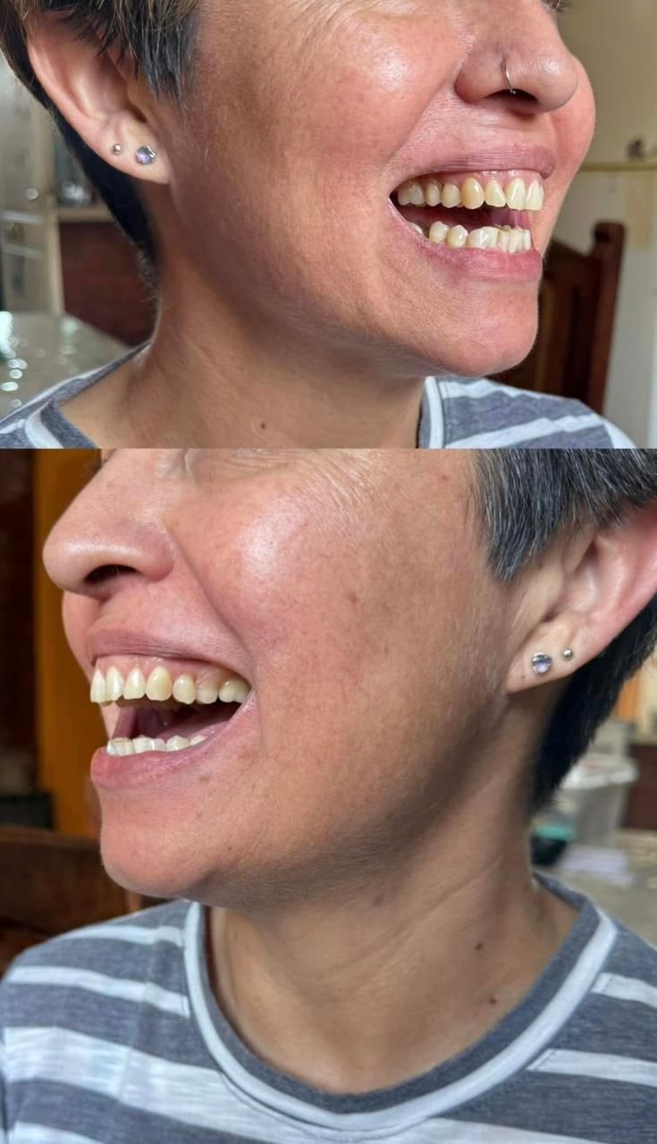 Dos fotografías en primer plano de una persona sonriendo, mostrando los dientes; vistiendo una camisa a rayas.