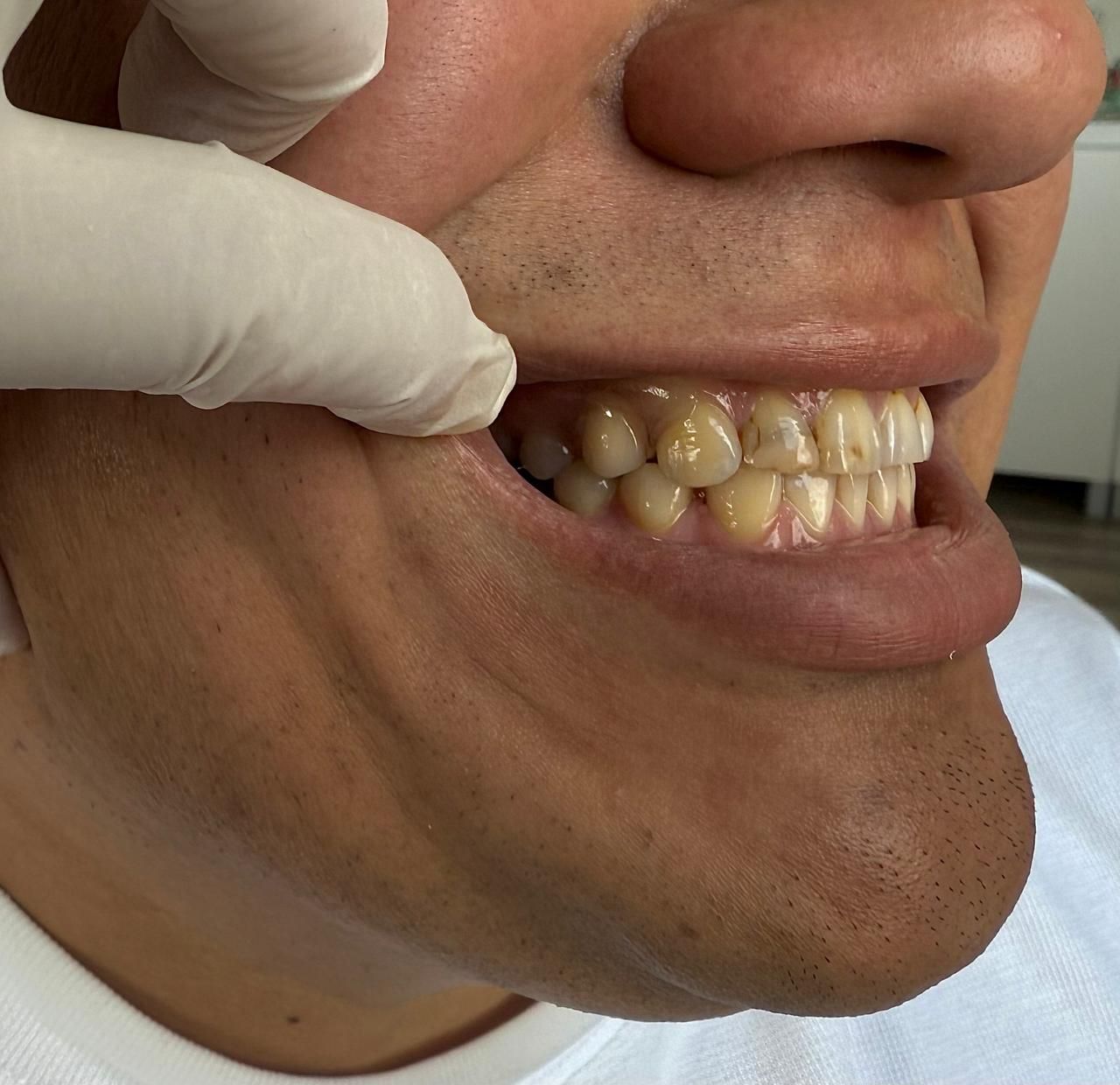 Primer plano de unos dientes que están siendo examinados; dientes amarillentos con una mano enguantada que tira hacia atrás de la mejilla.
