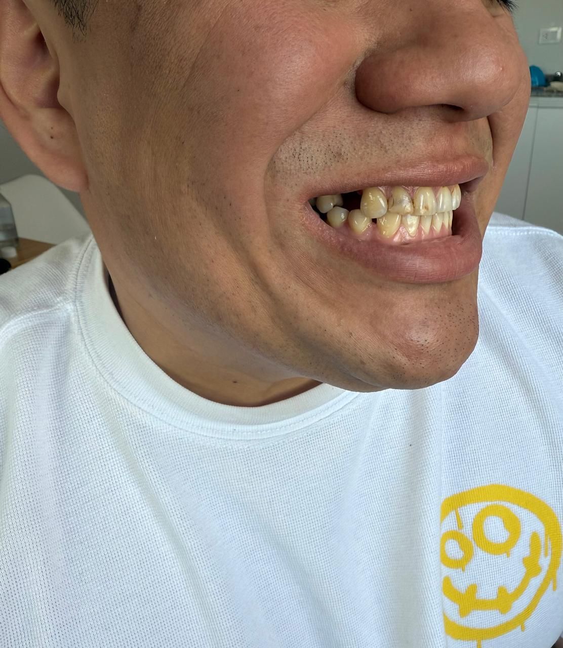 Hombre con dientes visibles, sonriendo, con camisa blanca. Le falta un diente.