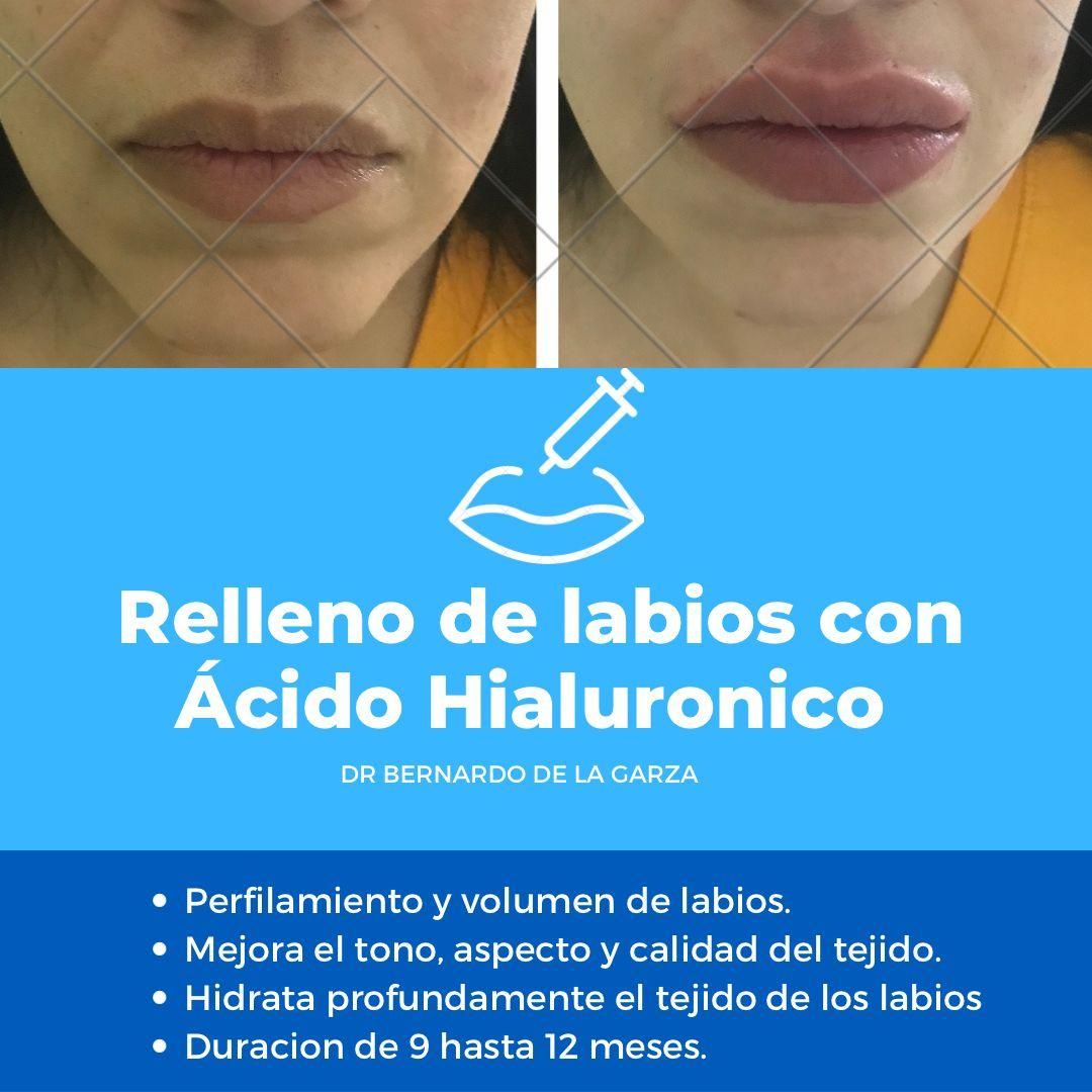 CLÍNICA Y SPA DE LA GARZA - Radiofrecuencia facial